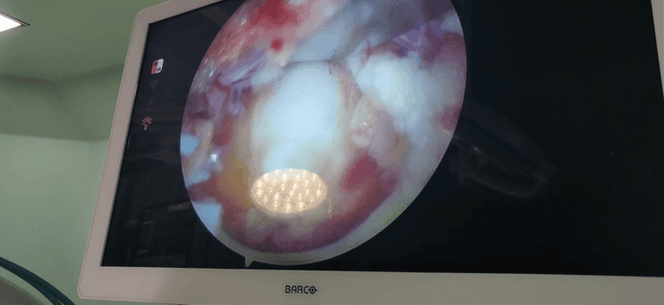 Endoscopic Spine Surgery Image 2